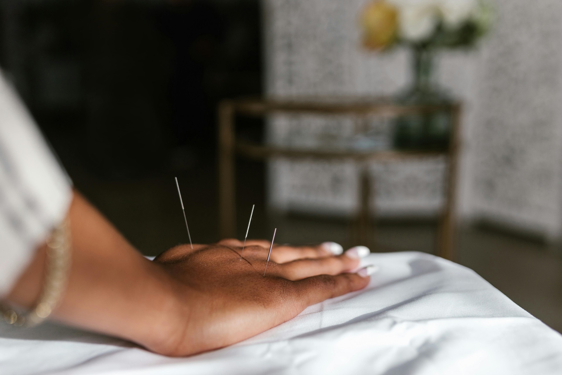 Image of dry needling on a hand in Albuquerque being performed